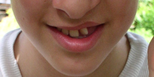 Pacient s rotovanými a chybějícími zuby na počátku orotodontické léčby